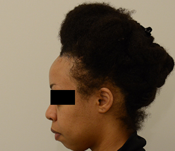 Hairline Lowering Before & After Image