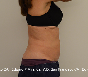 Coolsculpting Before & After Image